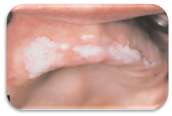 oral leukoplakia