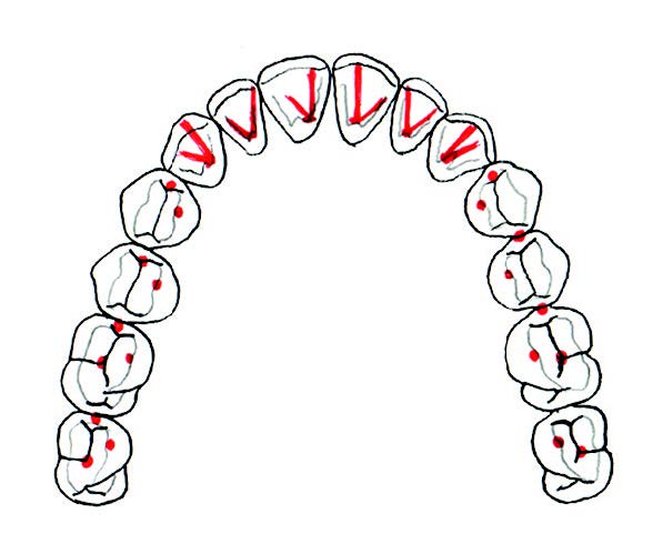 What is occlusal equilibration?