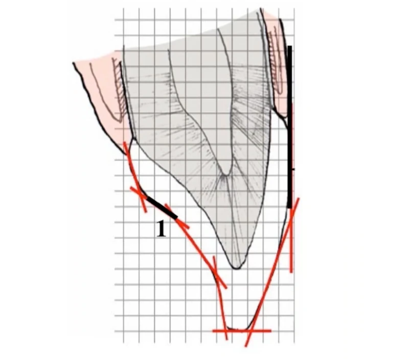 Anterior Guidance