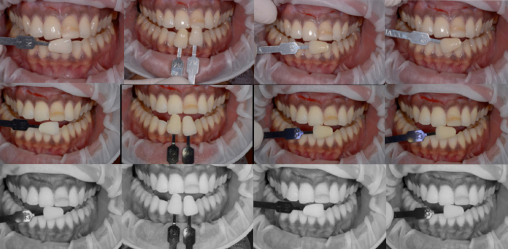 CrossPolarization-dental-photography
